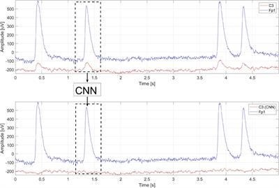 Implementation of a Convolutional Neural Network for Eye Blink Artifacts Removal From the Electroencephalography Signal